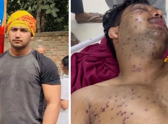 Sahil, injured during the Jantar Mantar protest in Delhi, is in critical condition! There is a risk of losing his eyesight; his uncle says pellet marks were seen on his body.